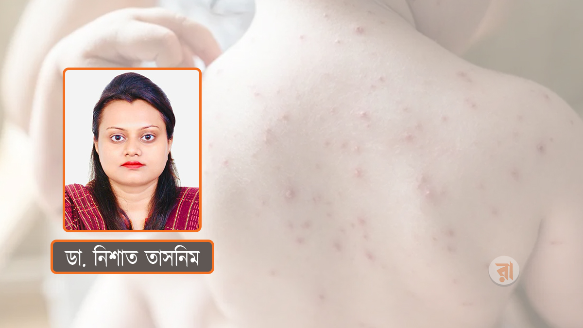 বসন্তে শিশুদের জলবসন্ত: কী করবেন, কী খাওয়াবেন?