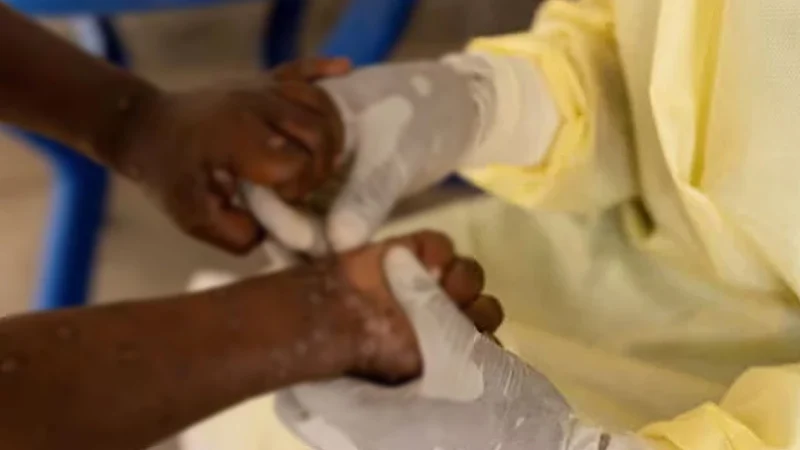 ইউরোপে এবার এমপক্স শনাক্ত